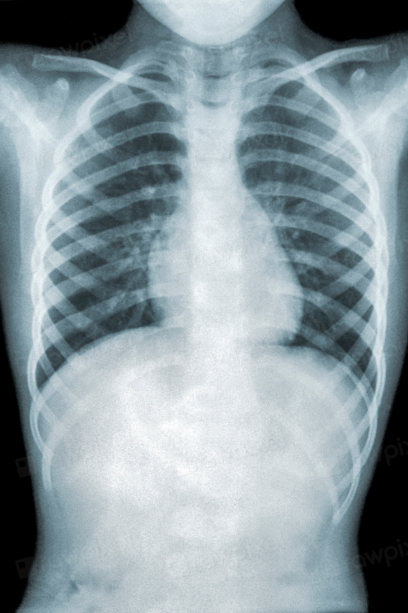 Chest x-ray patient mycoplasma pneumonia. | Free Photo - rawpixel