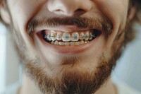 Man smile and teeth with braces person mouth human.