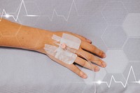 Close up of a patients hand with an IV