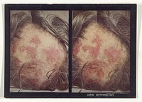 Lupus Erythematosus by Dr Selden I Rainforth