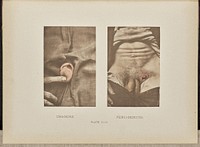 Chancre and periadenitis by Dr George Henry Fox