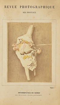 Arthropathie du genou, chez une ataxique (lésions anatomiques) by Arthur de Montmeja