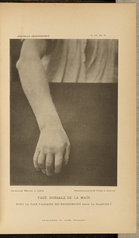 Face dorsale de la main dont la face palmaire est représentée dans la planche I by Albert Londe