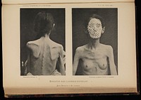 Two photographs of a woman suffering from anorexia