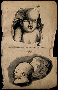 A malformed foetus. Wood engraving.