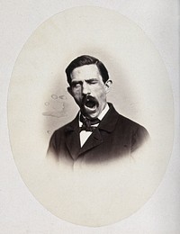 A man, head and shoulders; his face is contorted. Photograph by L. Haase after H.W. Berend, c. 1865.