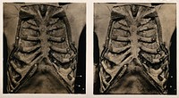 Anatomy: a dissection of the thorax: the thorax wall. Photograph, ca. 1900.