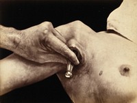 An operation in progress: a metal surgical implement is placed inside an incision in the armpit. Photograph by Félix Méheux, ca. 1900.