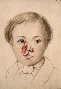 Tertiary, tubercular, ulcerating syphilide on the face of a child