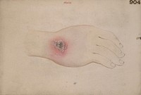 Pustular eruption on the hand of a man suffering from glanders