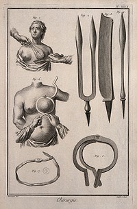 Surgery: instruments to perform a mastectomy. Engraving with etching by A.J. Defehrt after L.-J. Goussier.