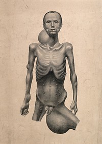 An emaciated naked man, displaying large swellings on his neck and groin, with smaller swellings visible on his chest, arms, abdomen and thigh. Process print, 18--.