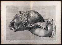 Dissection of the pregnant female abdomen, showing the skin peeled away to reveal the swollen uterus and the viscera, side view. Copperplate engraving by G. Scotin after I.V. Rymsdyk, 1774, reprinted 1851.