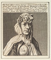 Elizabeth Hopkins of Oxford, showing a breast with cancer which was removed by Sir William Read. Engraving by M. Burghers, ca. 1700.