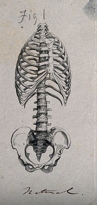Bones of the ribcage and pelvis: two figures, showing the appearance of the ribcage and spine in both its natural state, and when distorted by tight lacing. Etching with watercolour, 1864.