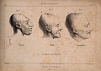 Three heads showing phrenological traits associated with insanity: a mentally defective person, a mad woman, and the murderer P.F. Lacenaire. Lithograph by C. Picard, 1842, after J.P. Thenot.