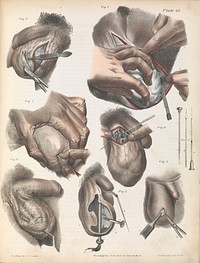 Plate LXII. Surgical techniques performed on the scrotum.