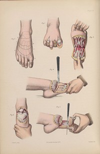 A course of operative surgery / with plates drawn from nature by M. Léveillé and coloured by hand under his direction ; by Christopher Heath.
