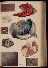 Principles and illustrations of morbid anatomy; adapted to the elements of M. Andral, and to the Cyclopaedia of practical medicine ... / being a complete series of coloured lithographic drawings from originals by the author; with descriptions and summary allusions to cases, symptoms, treatment, &c. ... By J. Hope.