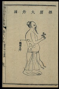 Chinese C18 woodcut: External medicine - Herpes zoster