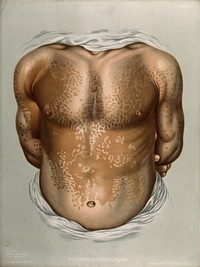 Discoloured skin on the torso and arms of a man suffering from pityriasis versicolor. Chromolithograph by E. Burgess, 1850/1880.