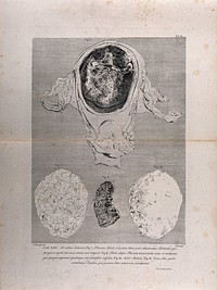 Dissection of the pregnant uterus at six months, showing the placenta and the decidua: four figures. Copperplate engraving by Menil after J.V. Rymsdyk, 1774, reprinted 1851.