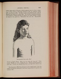 Miss K. R- aged 14, after treatment for anorexia