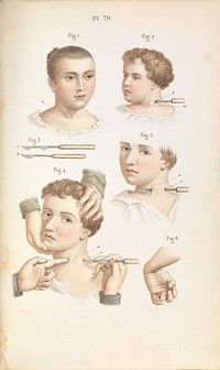 Plate 79, Surgical techniques for torticollis and club hand.