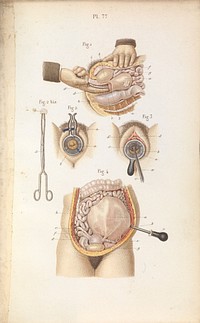 Plate 77, Dilation of cervix and preforation of membrane.