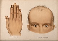 A hand with cracked and diseased fingernails; and the upper half of a face with severe hair loss (missing brows and lashes). Chromolithograph, c. 1888.