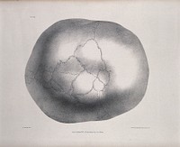 The deformed skull of James Cardinal as viewed from above. Lithograph after G. Scharf for Richard Bright, 1830.