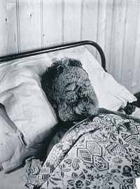 Gloucester smallpox epidemic, 1896: George Steel as a smallpox patient. Photograph by H.C.F., 1896.