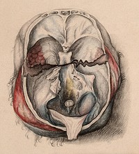 A dissected head with the top of the skull removed. Coloured drawing.