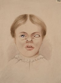 Girl with a fibrous tumour of the anterior surface of the left cornea