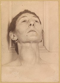 Woman with a cyst or cystic adenoma affecting the right lobe of the thyroid gland