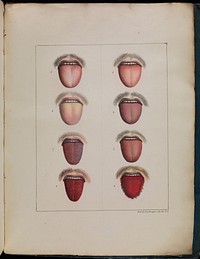 Observations sur la fièvre jaune, faites à Cadix, en 1819 / par MM. Pariset et Mazet ... et rédigées par M. Pariset.