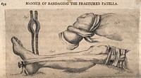 Methods of bandaging a fractured patella. Etching by J. Bell.