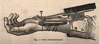 A sphygmograph: an instrument (also known as a 'pulsometer') for recording graphically the features of the pulse and variations in blood pressure. Wood engraving, 1850/1880.