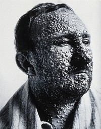 Small-pox: the face of a male sufferer. Photograph, 19--, of a photograph, ca. 1900 .