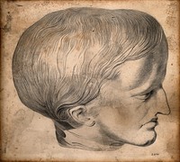 Head of James Cardinal: a man with a deformed skull. Drawing attributed to G. Scharf, c. 1830.