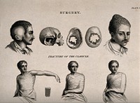 Abnormal heads and skulls, fractured and bandaged clavicle and a broken  leg bandaged in a splint. Engraving by W. Lowry, 1811, after J. Farey, the younger.