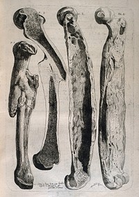 Diseased and broken femur bones: four figures. Etching by Lavalée after J. Gamelin, 1778.