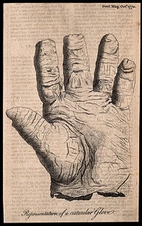 Skin of the hand peeled off like a glove as a result of a skin disease. Etching, 1770.