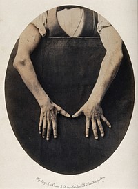 Wilhelm Haack, his hands and forearms exposed against a black background, thumbs pointing towards each other, revealing less mobility in right hand. Photograph by L. Haase after H.W. Berend, 1859.