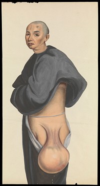 A man (Kwan Nanking) with a large pendent tumour hanging from his hip. Gouache, 18--, after Lam Qua, ca. 1837.