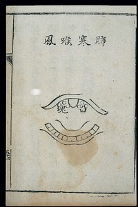 C18 Chinese woodcut: Lung-cold laryngitis