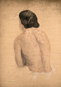 Back of a woman suffering from skin covered in a rash caused by syphilis. Watercolour by C. D'Alton, 1862.