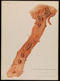 Illustrations of pathological anatomy : being a series of chromographed plates painted from nature immediately after death / with descriptive text by Alfred Kast and Theodor Rumpel ; English edition, revised and edited by M. Armand Ruffer.