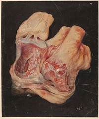 Dissected right knee joint of a patient with osteo-arthritis and locomotor ataxia