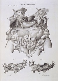Abnormalities of the formation of the foetus: conjoined twins